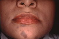 Erythema dyschromicum perstans